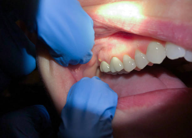 Best Emergency Wisdom Tooth Extraction in Progreso, TX